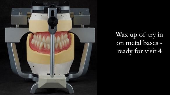 Rowan then uses the carved wax rims to set up the teeth. - teeth ready for try in. - Notice the bilateral crossbite arrangement