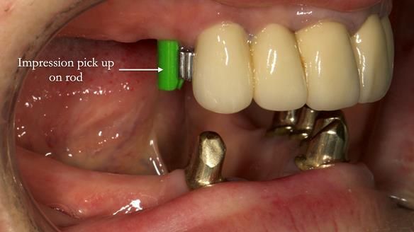 Newsletter 76: Jackie’s case – Telescopic overdenture & precision RPD (the tricky truth!)