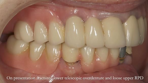Newsletter 76: Jackie’s case – Telescopic overdenture & precision RPD (the tricky truth!)