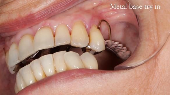 Newsletter 56 showing the making and fitting of a bilateral free end saddle upper removable partial denture (RPD) for patient with pemphigus