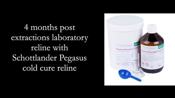 Newsletter 52 Managing Jo’s failing dentition with extractions and Mk 1/Mk 2 complete upper dentures and lower partial dentures FULL PROTOCOL