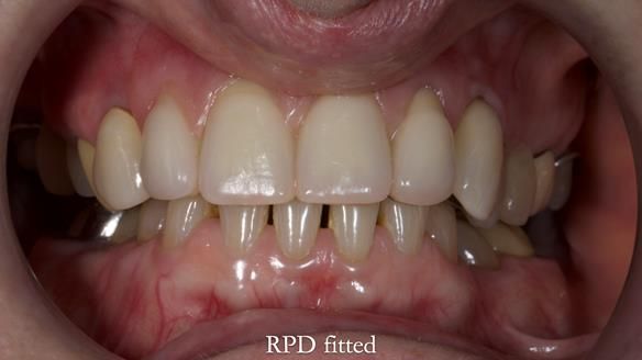 Newsletter 81 - Pam’s Story — how a partial denture changed her life (+ live walkthrough this Thursday)