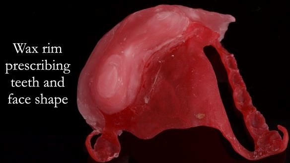 Upper metal base partial denture/occlusal stabilisation splint/obturator - full protocol