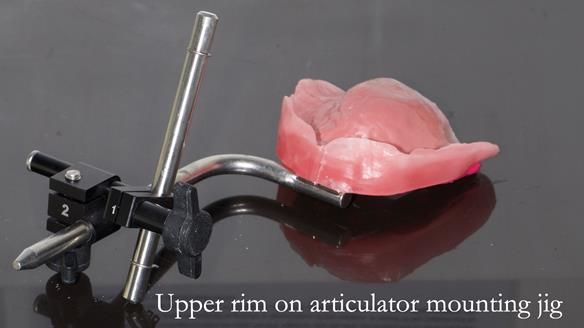 Finlay's Newsletter 62 provision of extractions and metal based complete dentures for Rafique