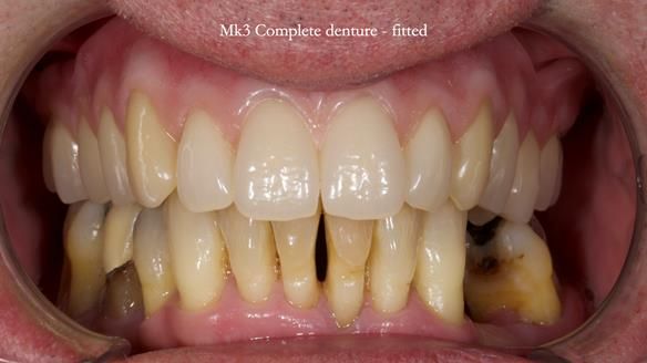 Newsletter 77: Jeremy’s case – immediate complete upper denture