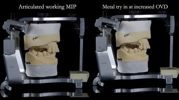 Finlay's Newsletter 64 case study - provision of a Kennedy class 2 metal based Scandinavian RPD for Ian