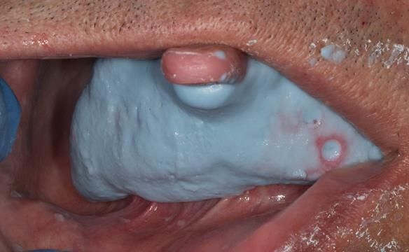 Figure 73 Definitive impression in situ after border moulding