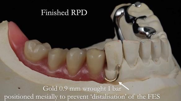 Finlay's Newsletter 61 provision of a lower unilateral free end saddle metal based partial denture for Joyce