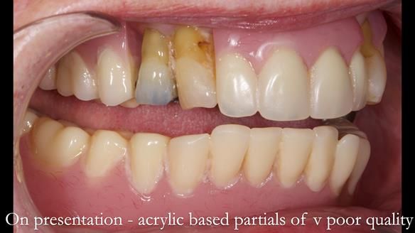 Finlay's Newsletter 59 Ultra hard partial dentures made for Gill