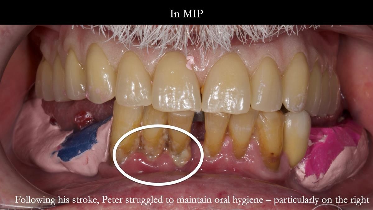 Newsletter 87 – Father Peter: A Partial Denture that needed Minor Miracle