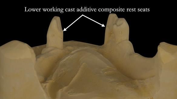 Finlay's Case Study Newsletter 40 - Immediate Mk 1 RPD to Definitive Mk 2 RPD - full protocol