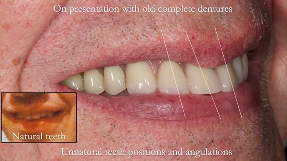 Newsletter 74: Ken’s Case Study Complete Dentures - Life Like and Age Appropriate