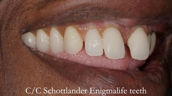 Newsletter 53 showing the making and fitting of ultra life-like dentures for Valena