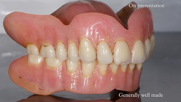 Newsletter 78: What do Clark Gable and a Locator® overdenture have in common?