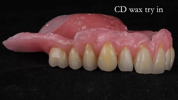 Finlay's Newsletter 62 provision of extractions and metal based complete dentures for Rafique