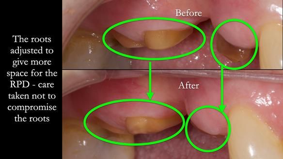 Finlay's Newsletter 60 Sylvia's upper Kennedy Class 2 Mod 1 metal based upper RPD