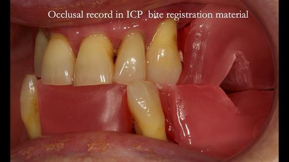 Finlay's Case Study Newsletter 40 - Immediate Mk 1 RPD to Definitive Mk 2 RPD - full protocol