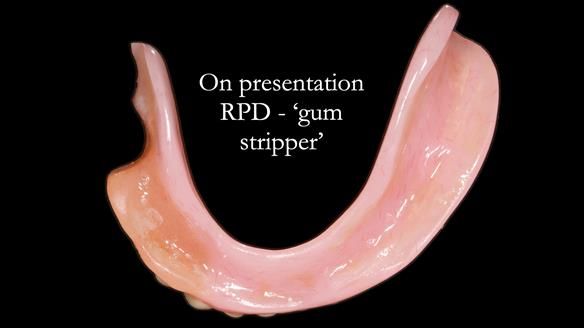 Finlay's Newsletter 59 Ultra hard partial dentures made for Gill