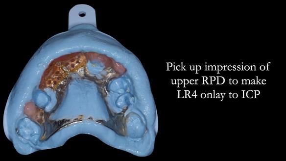 Eileen's transformation with upper and lower RPDs of Scandinavian hygienic design FULL PROTOCOL