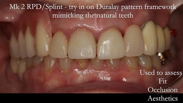Newsletter 51 Managing Anne’s failing dentition with distal extension base RPD/Splint FULL PROTOCOL