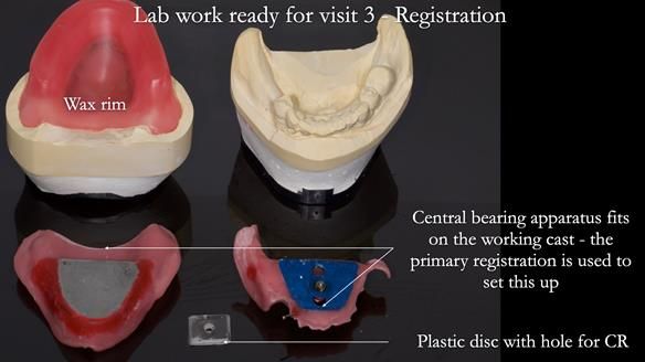 Newsletter 54 case presentation upper complete denture and lower Scandinavian designed hygienic partial denture for David