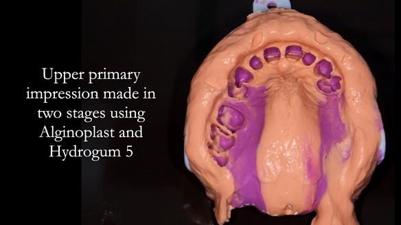 Finlay's Newsletter 64 case study - provision of a Kennedy class 2 metal based Scandinavian RPD for Ian