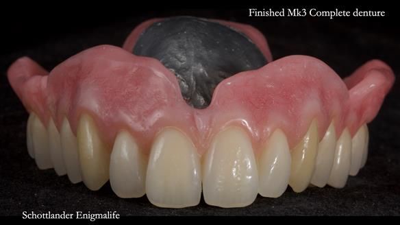 Newsletter 77: Jeremy’s case – immediate complete upper denture