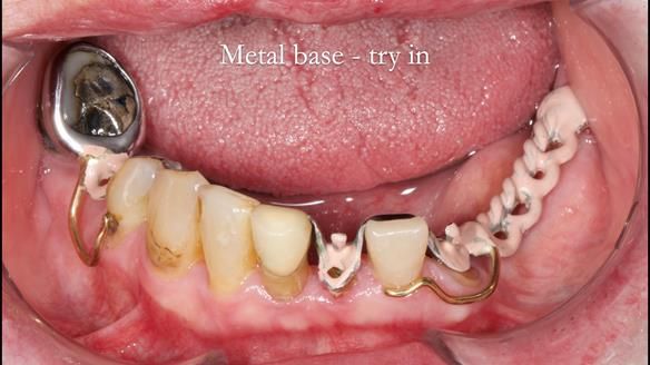 Newsletter 55 Provision of metal based partial dentures for Zephyrine with a repaired cleft lip and palate