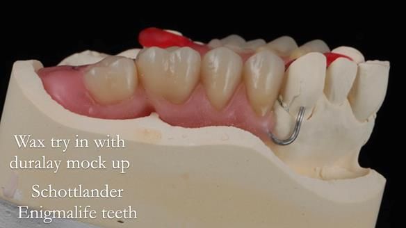 Finlay's Newsletter 60 Sylvia's upper Kennedy Class 2 Mod 1 metal based upper RPD
