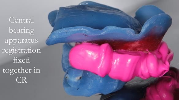 Finlay's Newsletter 58 Gasket upper partial denture for Zoe