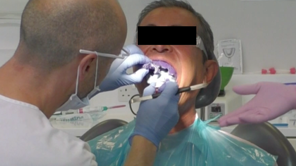 Figure 16 Careful removal of the impression from the mouth in two pieces - avoiding extraction the mobile teeth