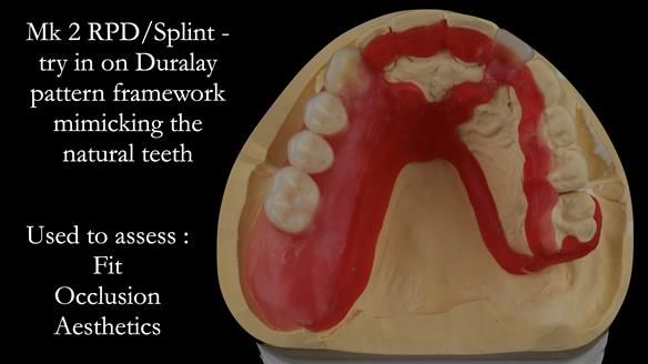 Newsletter 51 Managing Anne’s failing dentition with distal extension base RPD/Splint FULL PROTOCOL