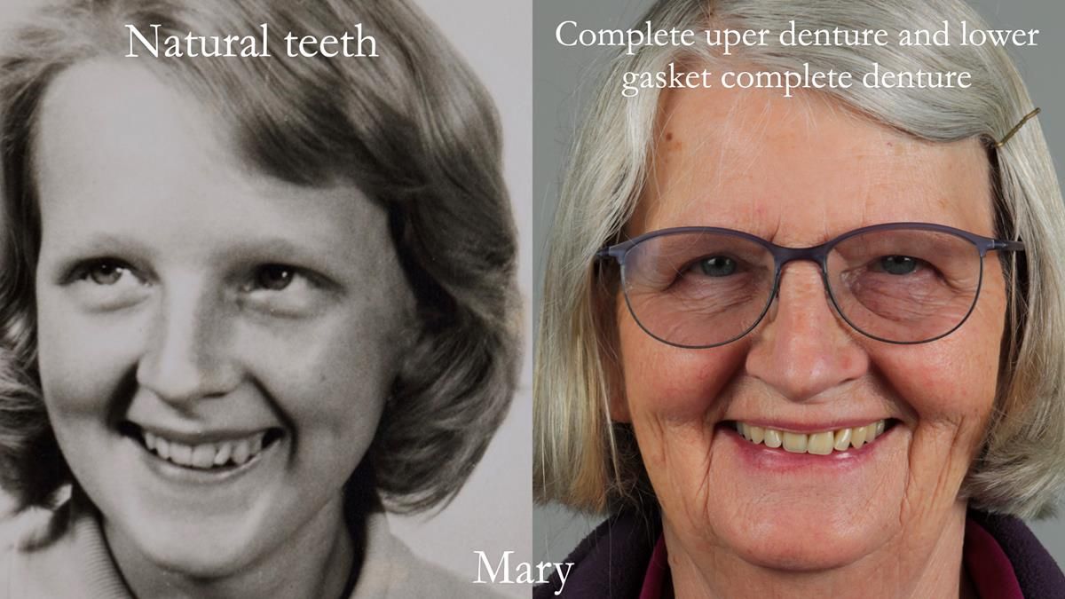Finlay's Newsletter 58 Gasket upper partial denture for Zoe