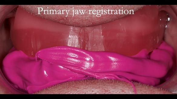 Complete denture Class II div 2 deep overbite Newsletter 39