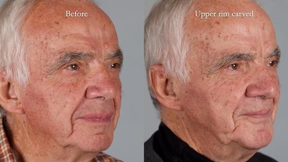 Newsletter 74: Ken’s Case Study Complete Dentures - Life Like and Age Appropriate