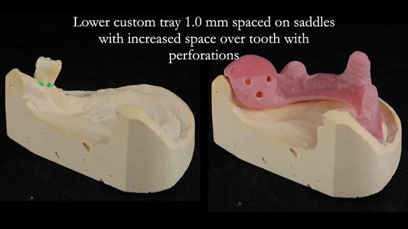 Finlay's Newsletter 59 Ultra hard partial dentures made for Gill
