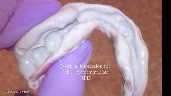 Newsletter 82 Mary - A complete upper and a one-tooth gasket denture