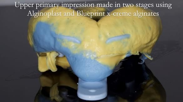 Newsletter 57 showcases the making and fitting process of implant-supported complete dentures for Alisdair