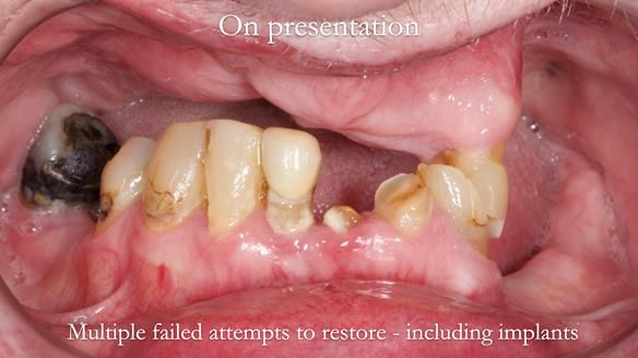 Newsletter 55 Provision of metal based partial dentures for Zephyrine with a repaired cleft lip and palate