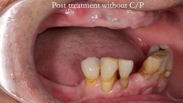 Newsletter 54 case presentation upper complete denture and lower Scandinavian designed hygienic partial denture for David