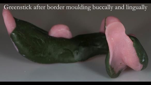 Newsletter 75: Marion’s case - Step-by-step complete denture workflow