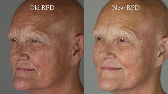 Newsletter 81 - Pam’s Story — how a partial denture changed her life (+ live walkthrough this Thursday)