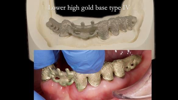 Newsletter 76: Jackie’s case – Telescopic overdenture & precision RPD (the tricky truth!)