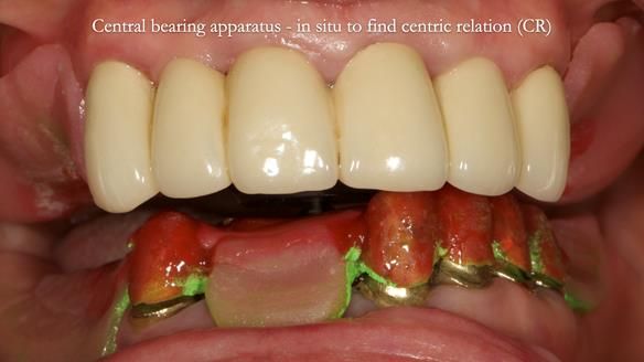 Newsletter 76: Jackie’s case – Telescopic overdenture & precision RPD (the tricky truth!)