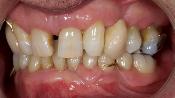 Newsletter 86 Peter the Architect — precision removable partial dentures case study