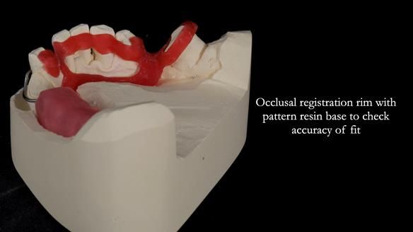 Newsletter 55 Provision of metal based partial dentures for Zephyrine with a repaired cleft lip and palate