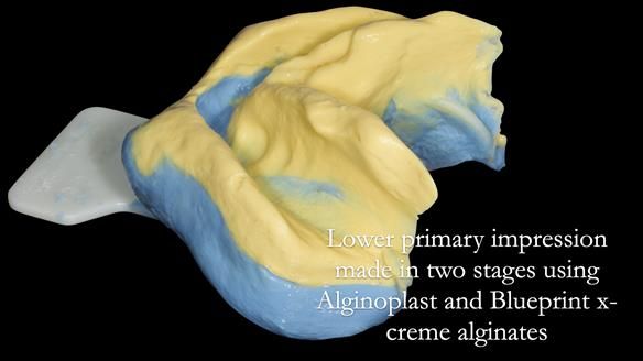 Newsletter 53 showing the making and fitting of ultra life-like dentures for Valena