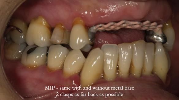 Finlay's Newsletter 63 Case study provision of metal based Scandinavian RPD - functional 10 years on