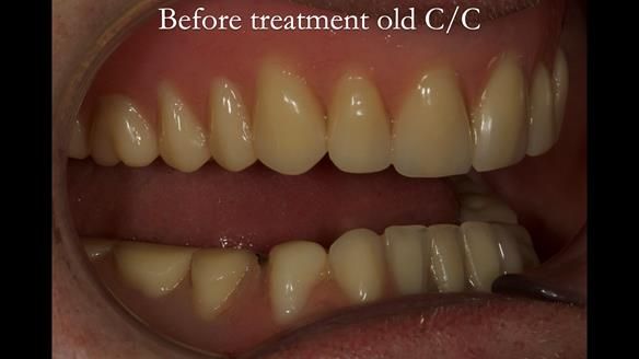 Complete denture Class II div 2 deep overbite Newsletter 39