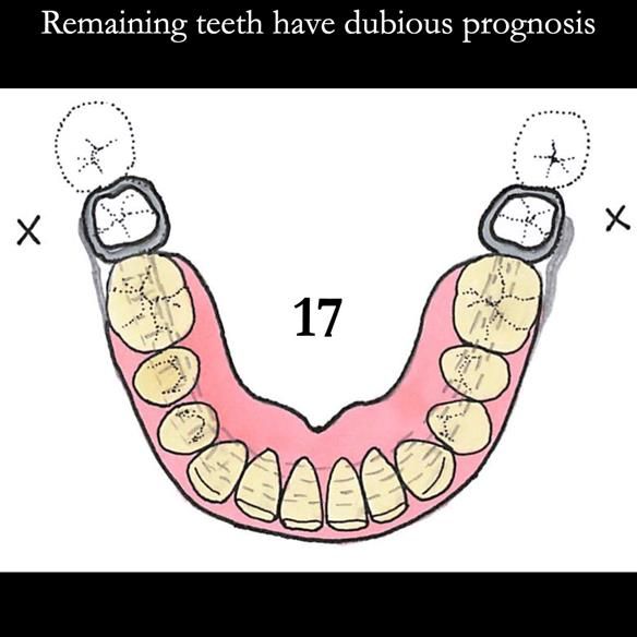 Universal Scandinavian partial denture designs